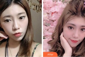 杭州太學(xué)眼科門診部董媛整形價格表附眼部綜合案例展示