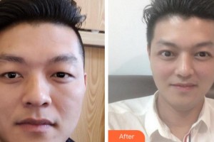 杭州太學(xué)眼科門診部周玉柱整形價格表附切開雙眼皮案例展示