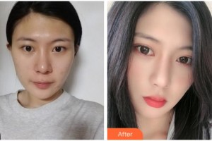 杭州太學(xué)眼科門診部余威德整形價格表附眼部綜合案例展示