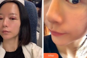 杭州太學(xué)眼科門診部林丕容整形價格表附切開雙眼皮案例展示