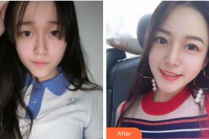 杭州口腔醫(yī)院劉敏整形價格表附切開雙眼皮案例展示