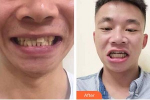 杭州口腔醫(yī)院陳丹鵬整形價格表附牙齒隱形矯正案例展示