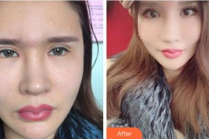 杭州愛爾眼科醫(yī)院金曉紅整形價格表附眼部修復(fù)案例展示