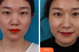 杭州愛爾眼科醫(yī)院朱雅琴整形價格表附切開雙眼皮案例展示