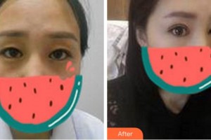 杭州愛爾眼科醫(yī)院楊羿整形價格表附切開雙眼皮案例展示