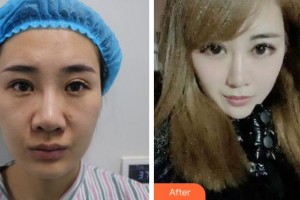 杭州愛爾眼科醫(yī)院徐亞軍整形價格表附切開雙眼皮案例展示