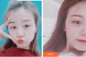 杭州西湖之江眼科醫(yī)院俞阿勇整形價格表附切開雙眼皮案例展示