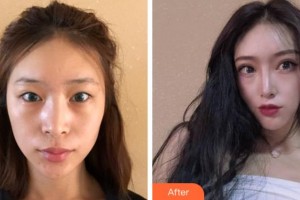 杭州西湖之江眼科醫(yī)院梁遠波整形價格表附切開雙眼皮案例展示