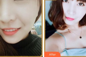 寧波珈禾整形?？漆t(yī)院金正旺整形價(jià)格表附眼部綜合案例展示