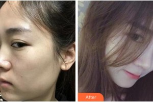 寧波珈禾整形?？漆t(yī)院鮑海萍整形價(jià)格表附膨體隆鼻案例展示