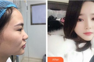 寧波珈禾整形?？漆t(yī)院龔濤整形價(jià)格表附鼻部綜合案例展示
