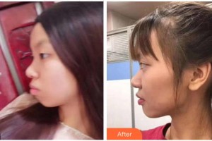 寧波珈禾整形專科醫(yī)院王昊整形價(jià)格表附金屬托槽矯正案例展示