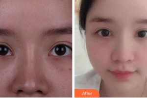 寧波尚麗整形美容醫(yī)院安薇整形價(jià)格表附眼部修復(fù)案例展示