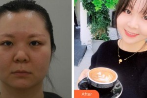 寧波尚麗整形美容醫(yī)院姜艷整形價(jià)格表附埋線提升案例展示