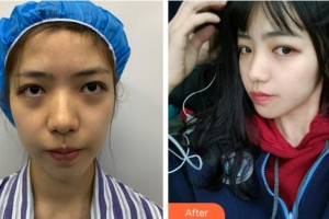 寧波美萊整形美容醫(yī)院劉邦瑜整形價(jià)格表附埋線提升案例展示