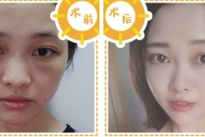 寧波協(xié)和儷人醫(yī)療美容門診部丁芳芳醫(yī)師整形價(jià)格表附埋線提升案例展示