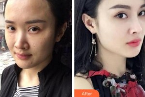 寧波協(xié)和儷人醫(yī)療美容門診部方振玉整形價(jià)格表附熱瑪吉案例展示