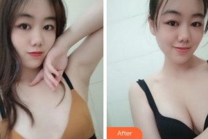 寧波壬美醫(yī)療美容醫(yī)院蔣聰玲整形價(jià)格表附自體脂肪隆胸案例展示