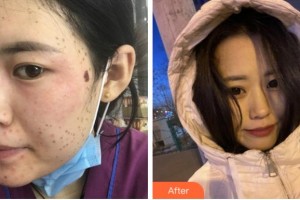 寧波壬美醫(yī)療美容醫(yī)院陳恩霞整形價(jià)格表附激光美膚激光案例展示