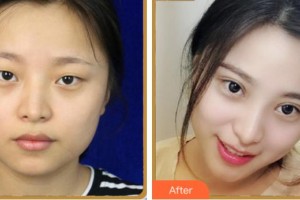 寧波尚麗整形美容醫(yī)院姜昌均整形價(jià)格表附眼部綜合案例展示