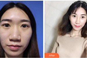 寧波美萊整形美容醫(yī)院韓春整形價(jià)格表附鼻部綜合案例展示