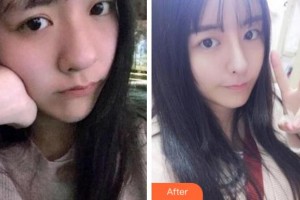 寧波協(xié)和儷人醫(yī)療美容門(mén)診部帥霞整形價(jià)格表附熱瑪吉案例展示