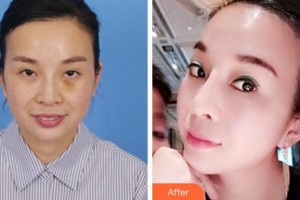 寧波美萊整形美容醫(yī)院張瑋整形價(jià)格表附埋線(xiàn)提升案例展示