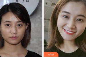 寧波孫敏醫(yī)療美容診所孫敏整形價(jià)格表附埋線(xiàn)提升案例展示