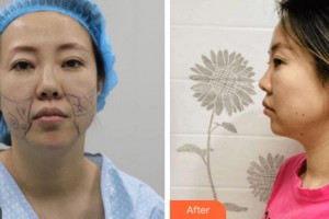 寧波大學(xué)醫(yī)學(xué)院附屬醫(yī)院整形外科任森洋整形價(jià)格表附埋線(xiàn)提升案例展示