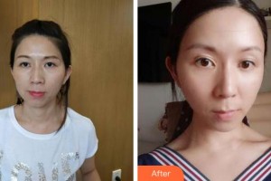 寧波鄞州人民醫(yī)院整形美容科童燕萍整形價(jià)格表附熱拉提案例展示