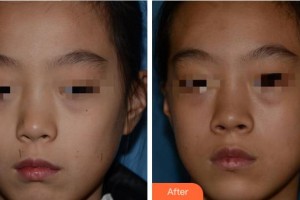 寧波壬美醫(yī)療美容醫(yī)院徐開(kāi)勇整形價(jià)格表附激光點(diǎn)痣案例展示