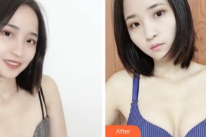 寧波珈禾整形專(zhuān)科醫(yī)院鄧小榮整形價(jià)格表附自體脂肪隆胸案例展示