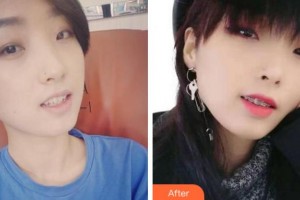 寧波珈禾整形專(zhuān)科醫(yī)院鮑琴兒整形價(jià)格表附金屬托槽矯正案例展示