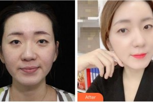 寧波市第二醫(yī)院整形美容外科馬越波整形價(jià)格表附熱拉提案例展示