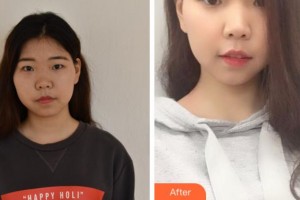 寧波鄔立新醫(yī)療美容診所鄔立新整形價(jià)格表附激光祛斑案例展示