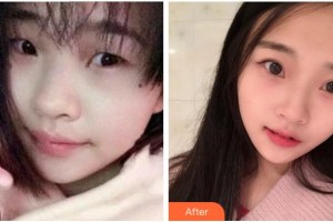 寧波美仁整形美容醫(yī)院潘杰整形價(jià)格表附切開(kāi)雙眼皮案例展示