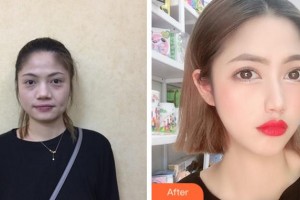 寧波壹加壹美容醫(yī)院元慶植整形價(jià)格表附埋線提升案例展示