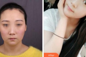 寧波陳標(biāo)新整形美容醫(yī)院權(quán)鏞頊整形價(jià)格表附埋線提升案例展示