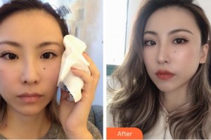 寧波薇琳醫(yī)療美容門(mén)診部徐廷五整形價(jià)格表附埋線提升案例展示