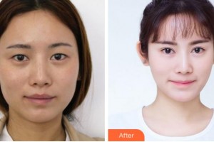 寧波米陽(yáng)整形門(mén)診部羅遠(yuǎn)洪整形價(jià)格表附眼部綜合案例展示