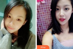 寧波明州醫(yī)院整形美容中心林士隆整形價(jià)格表附眼部綜合案例展示