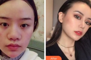 寧波唯格醫(yī)療美容門(mén)診部李曉霞整形價(jià)格表附鼻中隔軟骨隆鼻案例展示