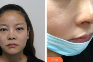 寧波復(fù)大皮膚病?？漆t(yī)院徐暉整形價格表附隆鼻案例展示