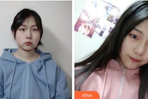 寧波復(fù)大皮膚病專科醫(yī)院武文帥整形價格表附埋線提升案例展示