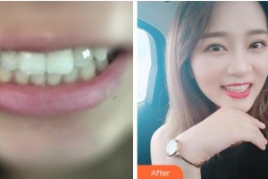 寧波江北口腔醫(yī)院韓春耀整形價格表附金屬托槽矯正案例展示