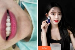 寧波江北口腔醫(yī)院陳镕榕整形價格表附牙齒隱形矯正案例展示