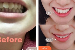 寧波拜博拜爾口腔醫(yī)院林東杰整形價格表附牙齒隱形矯正案例展示