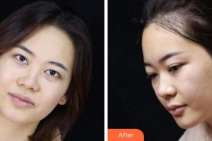 寧波鄞州眼科醫(yī)院程軍英整形價格表附眼部綜合案例展示