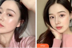 寧波鄞州眼科醫(yī)院朱隆斌整形價格表附眼部綜合案例展示