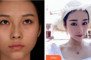 寧波鄞州眼科醫(yī)院孔慶輝整形價格表附切開雙眼皮案例展示